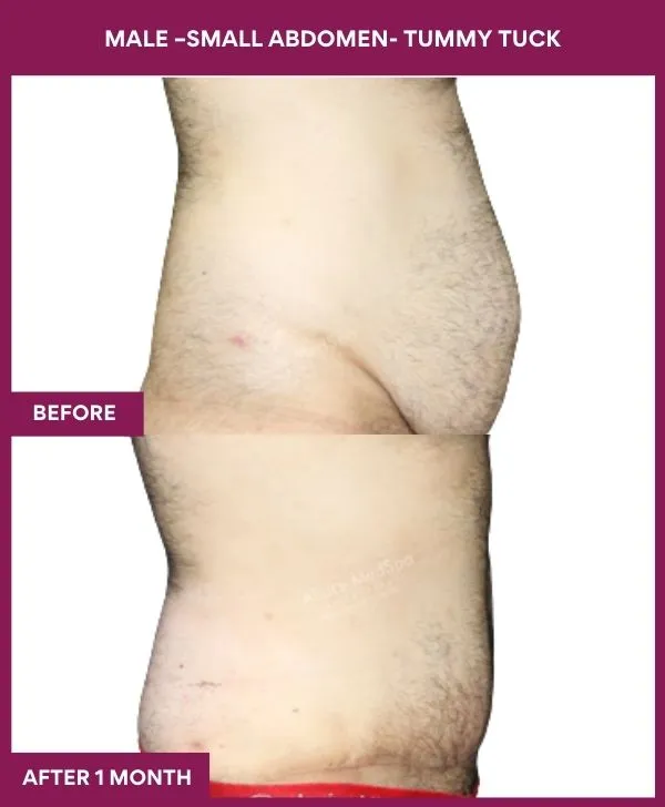 5 MALE –SMALL ABDOMEN- TUMMY TUCK_48 (3)