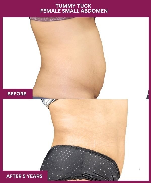 5 Tummy Tuck Female Small Abdomen (2)