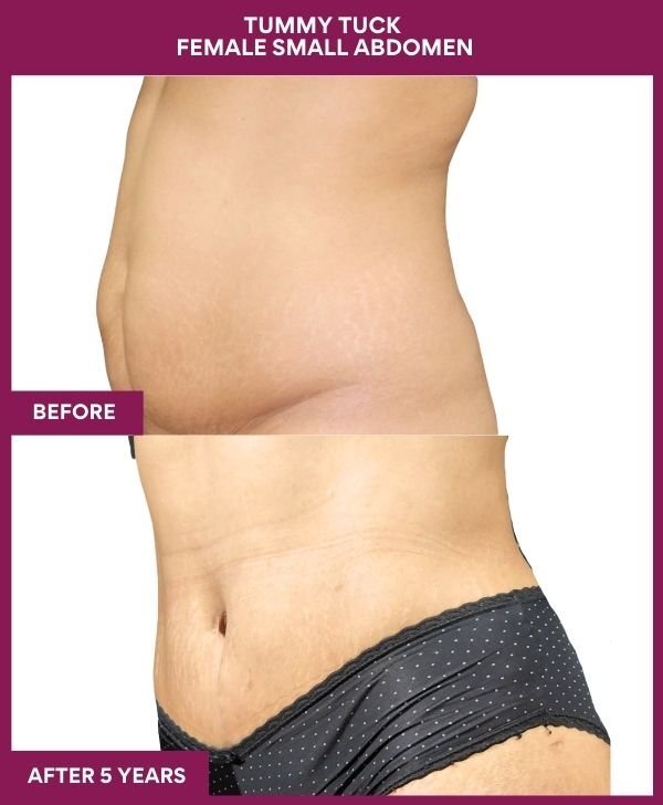 5 Tummy Tuck Female Small Abdomen (3)
