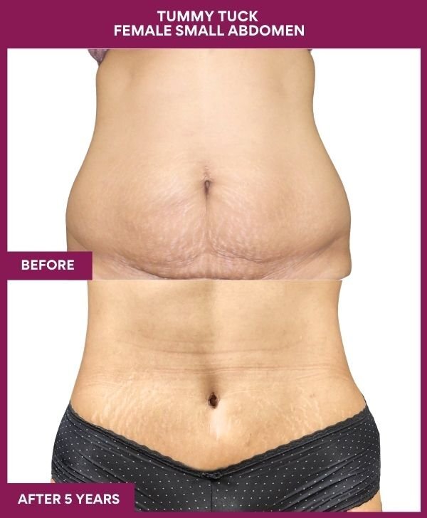 5 Tummy Tuck Female Small Abdomen