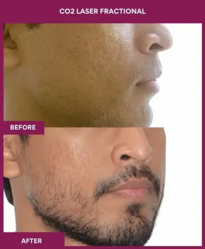 6 CO2 Laser Fractional (2)