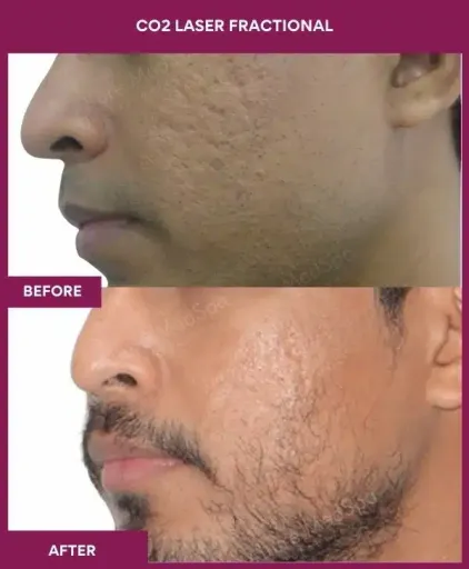 6 CO2 Laser Fractional (3)