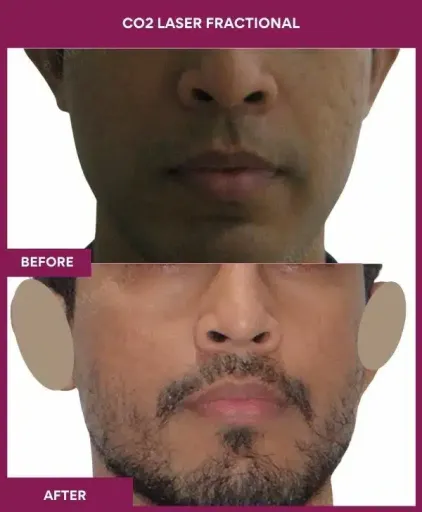 6 CO2 Laser Fractional