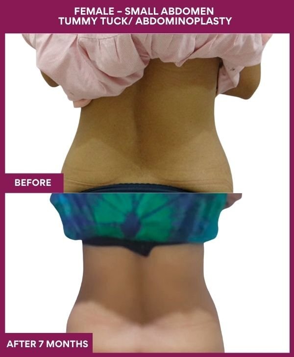 6 FEMALE – SMALL ABDOMEN TUMMY TUCK_ ABDOMINOPLASTY (2)