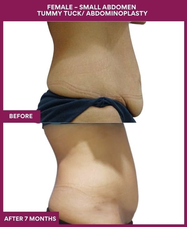 6 FEMALE – SMALL ABDOMEN TUMMY TUCK_ ABDOMINOPLASTY (3)