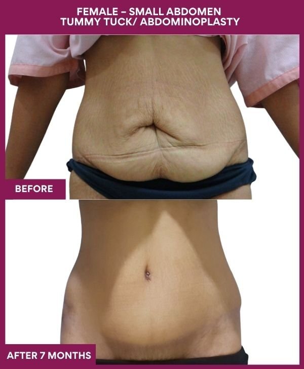 6 FEMALE – SMALL ABDOMEN TUMMY TUCK_ ABDOMINOPLASTY