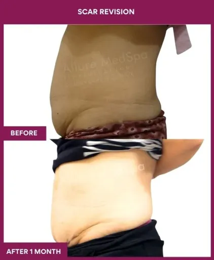 6 Scar Revision (3)_6_