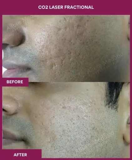 7 CO2 Laser Fractional (2)