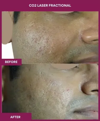 7 CO2 Laser Fractional