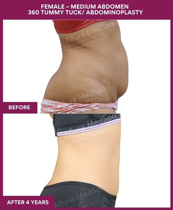 7 FEMALE – MEDIUM ABDOMEN 360 TUMMY TUCK_ ABDOMINOPLASTY (2)