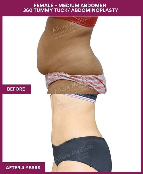 7 FEMALE – MEDIUM ABDOMEN 360 TUMMY TUCK_ ABDOMINOPLASTY (3)