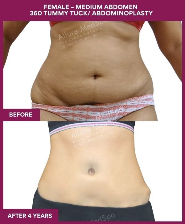 7 FEMALE – MEDIUM ABDOMEN 360 TUMMY TUCK_ ABDOMINOPLASTY