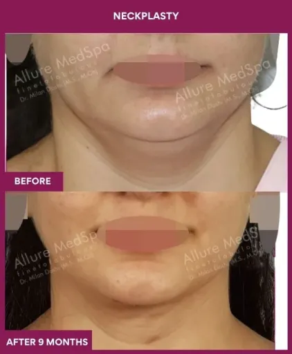 Neckplasty Surgery in Mumbai