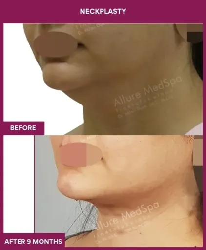 Neckplasty Surgery in Mumbai