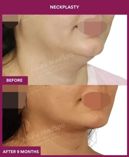 Neckplasty Surgery in Mumbai