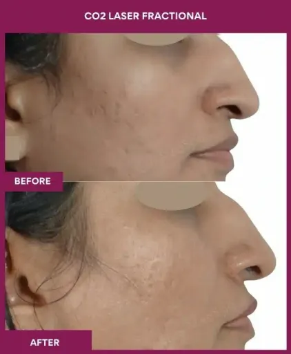 8 CO2 Laser Fractional (2)