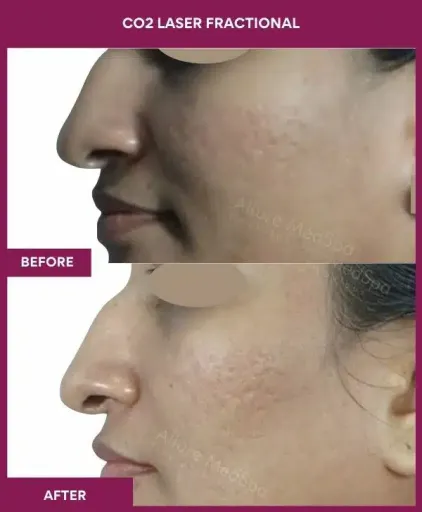 8 CO2 Laser Fractional (3)