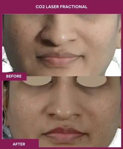 8 CO2 Laser Fractional