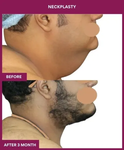 Male Neckplasty in Mumbai