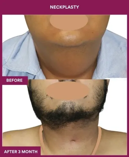 Male Neckplasty in Mumbai