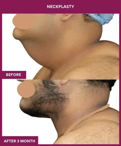 Male Neckplasty in Mumbai