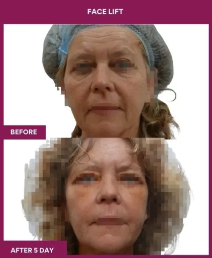 9 FACE LIFT_20_ (1)