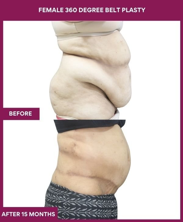 FEMALE 360 DEGREE BELT PLASTY in Mumbai, India