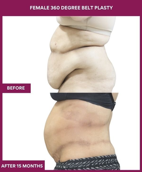 FEMALE 360 DEGREE BELT PLASTY in Mumbai, India