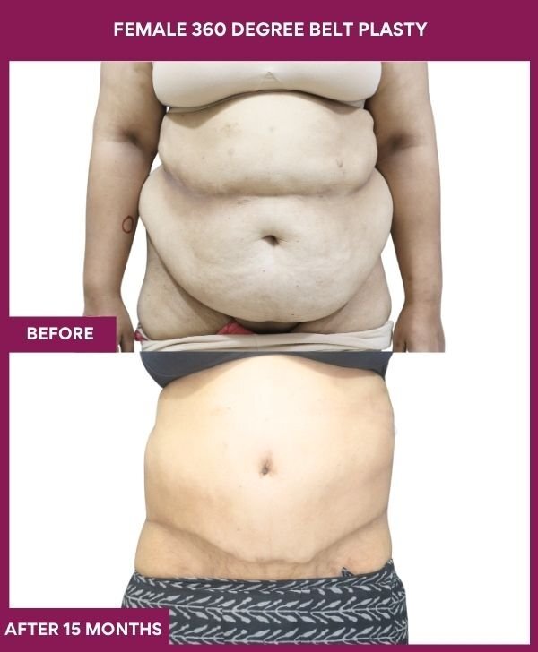 FEMALE 360 DEGREE BELT PLASTY in Mumbai, India