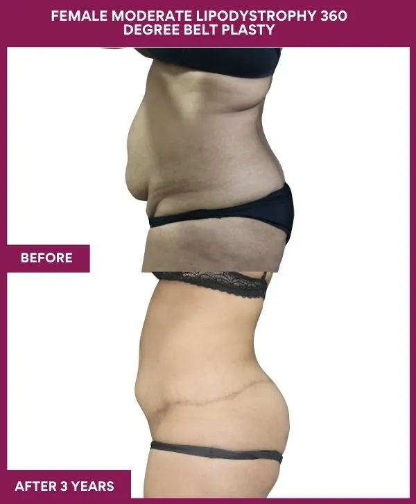 FEMALE MODERATE LIPODYSTROPHY 360 DEGREE BELT PLASTY (3)