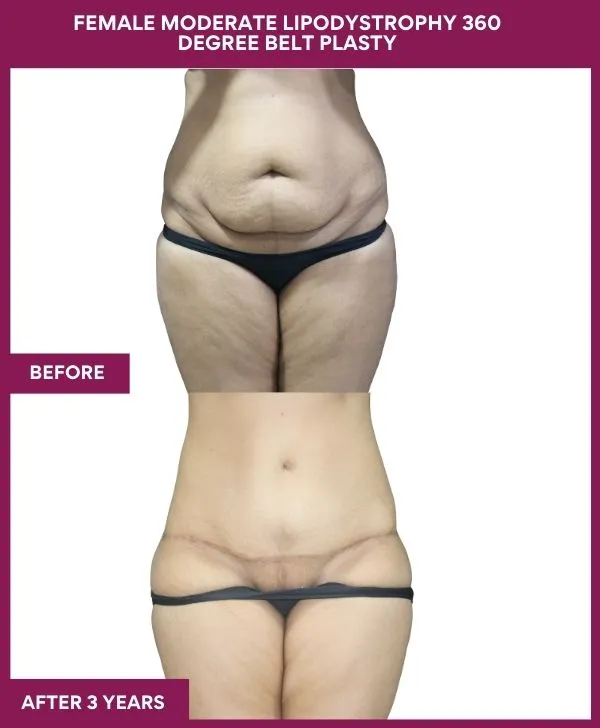 FEMALE MODERATE LIPODYSTROPHY 360 DEGREE BELT PLASTY (4)_18_
