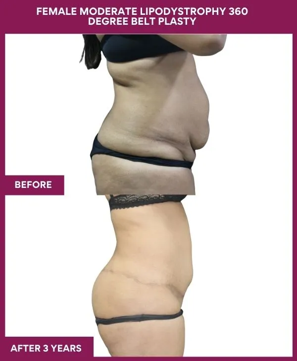 FEMALE MODERATE LIPODYSTROPHY 360 DEGREE BELT PLASTY in Mumbai, India