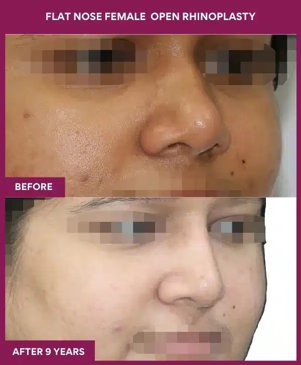 FLAT NOSE FEMALE OPEN RHINOPLASTY in Mumbai, India