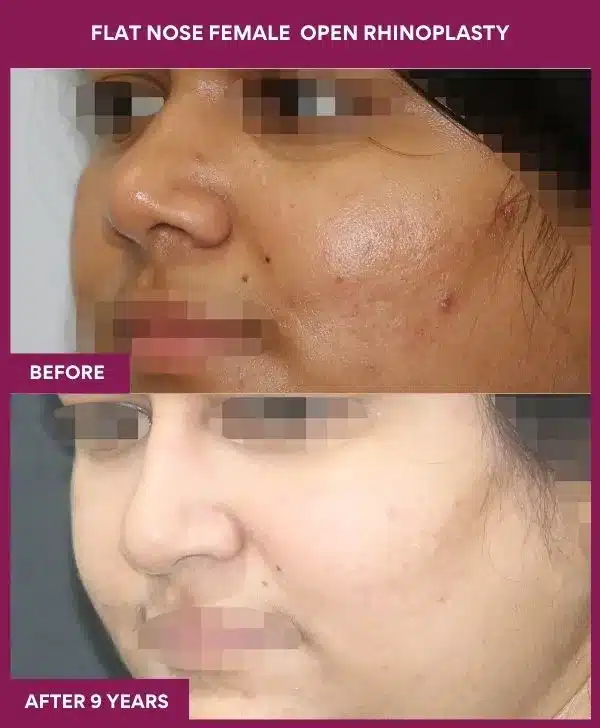FLAT NOSE FEMALE OPEN RHINOPLASTY in Mumbai, India