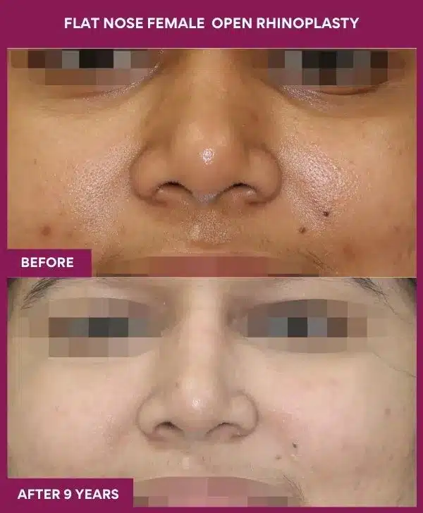 FLAT NOSE FEMALE OPEN RHINOPLASTY in Mumbai, India