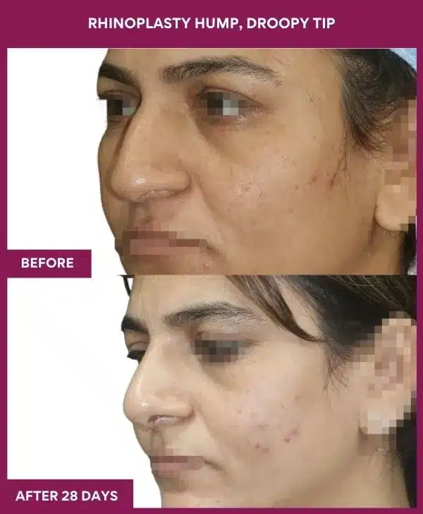 RHINOPLASTY HUMP, DROOPY TIP in Mumbai, India