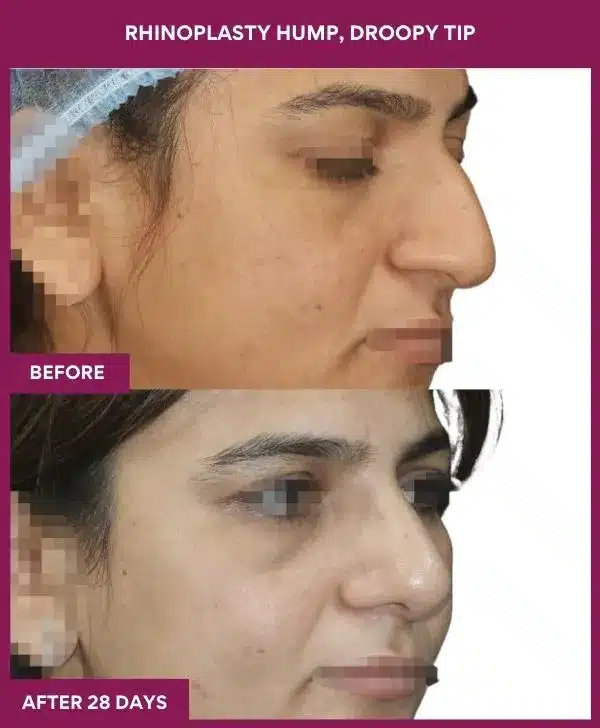RHINOPLASTY HUMP, DROOPY TIP in Mumbai, India