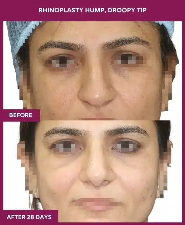 RHINOPLASTY HUMP, DROOPY TIP in Mumbai, India