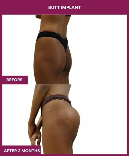 1 BUTT implant (2)