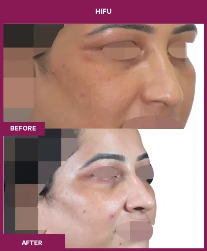 Hifu Treatment in Mumbai