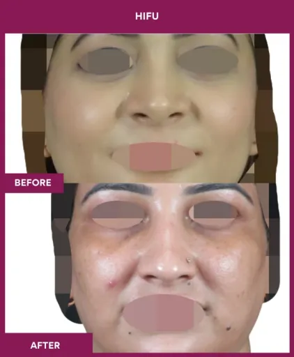 Hifu Treatment in Mumbai