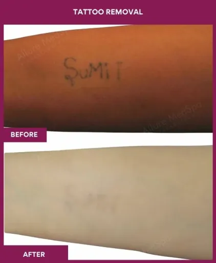 Tattoo removal treatment in Mumbai