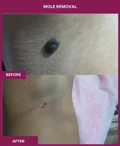 12 Mole Removal