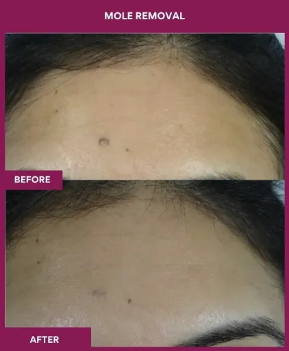 15 Mole Removal (2)