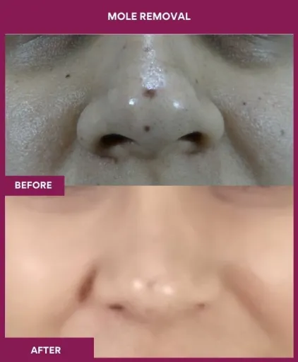 15 Mole Removal (3)