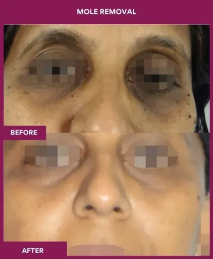 16 Mole Removal (2)_3_