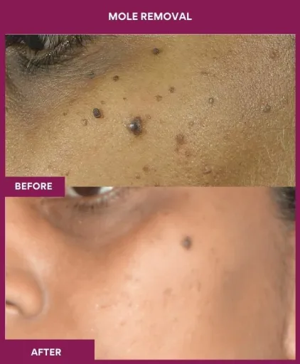 16 Mole Removal