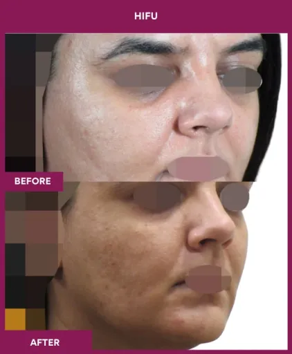 Hifu Treatment in Mumbai