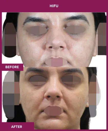 Hifu Treatment in Mumbai