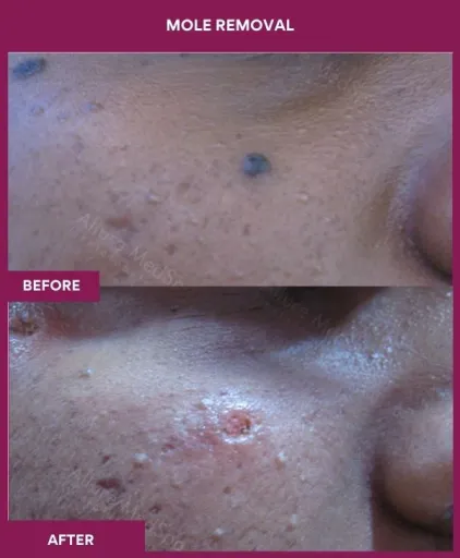 2 Mole Removal